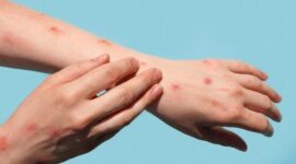 Kasus Cacar Monyet Makin meningkat
