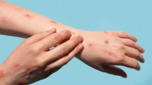 KASUS CACAR MONYET MAKIN MENINGKAT KASUS CACAR MONYET MAKIN MENINGKAT