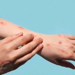 9 CARA PENGOBATAN CACAR AIR YANG EFEKTIF DAN AMAN