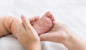 10 CARA EFEKTIF PENGOBATAN CAMPAK PADA ANAK: PANDUAN LENGKAP UNTUK PARA ORANG TUA