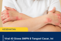 Viral 43 Siswa SMPN 8 Tangsel Cacar, Ini kata ahli cacar